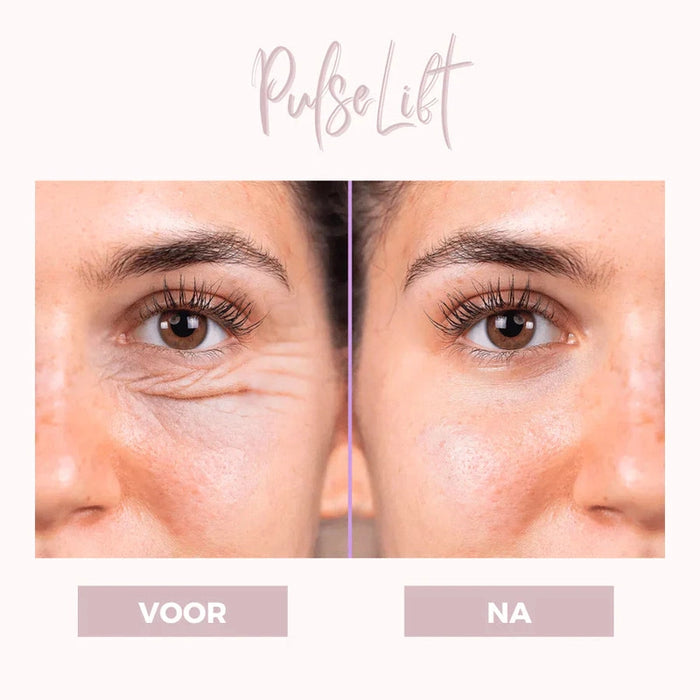 LumeVibe | Ooglift apparaat | Dermatologisch Ontwikkeld