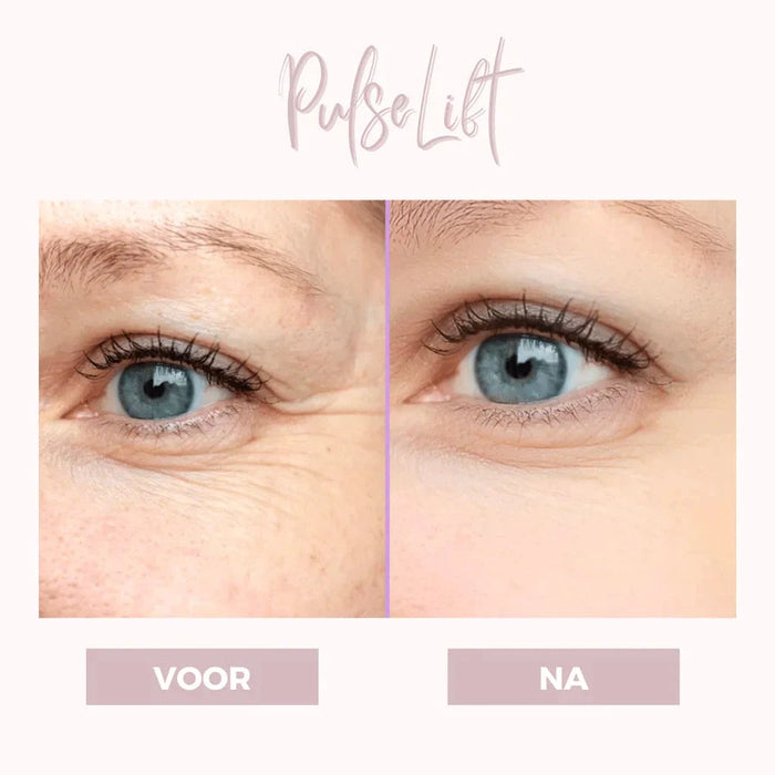 LumeVibe | Ooglift apparaat | Dermatologisch Ontwikkeld